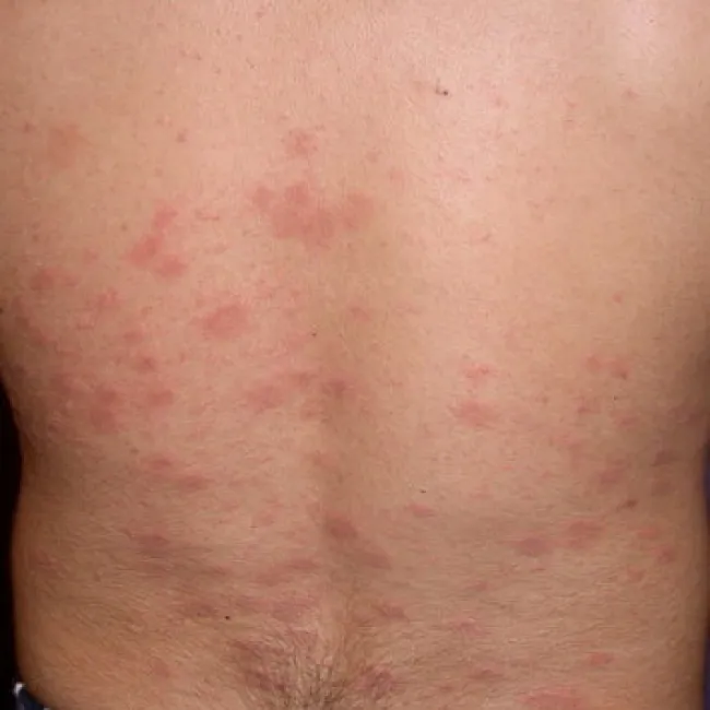 łupież różowy giberta zdjęcia