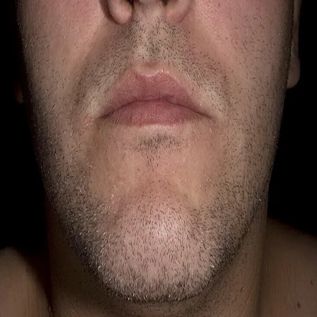 łuszcząca się skóra na brodzie