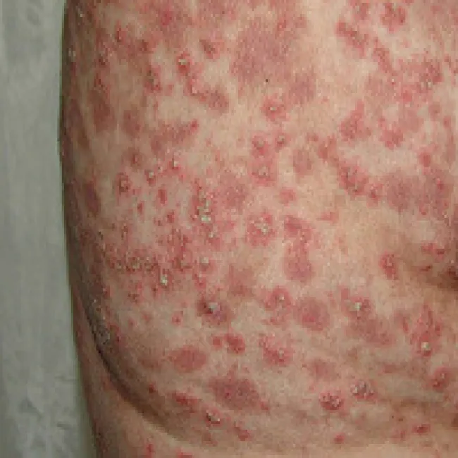 łuszczyca krostkowa