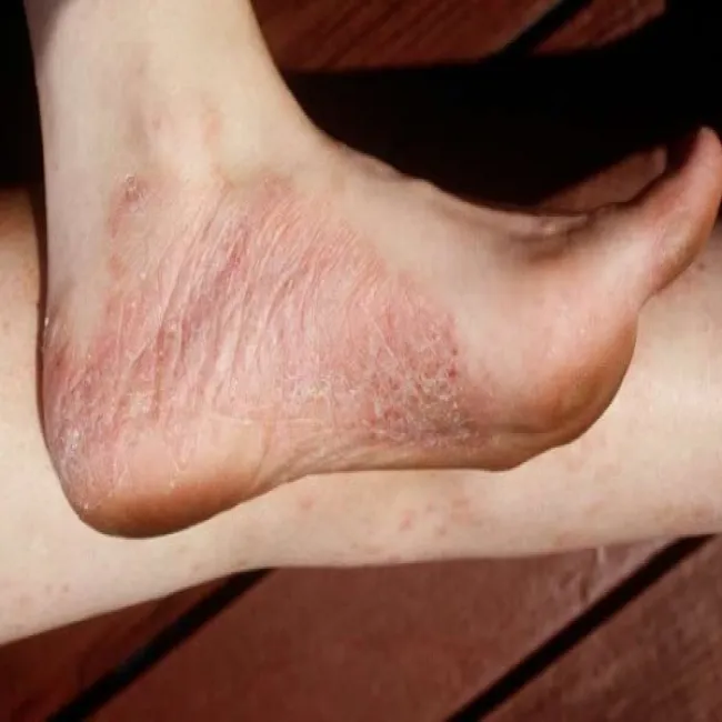 łuszczyca na stopach 