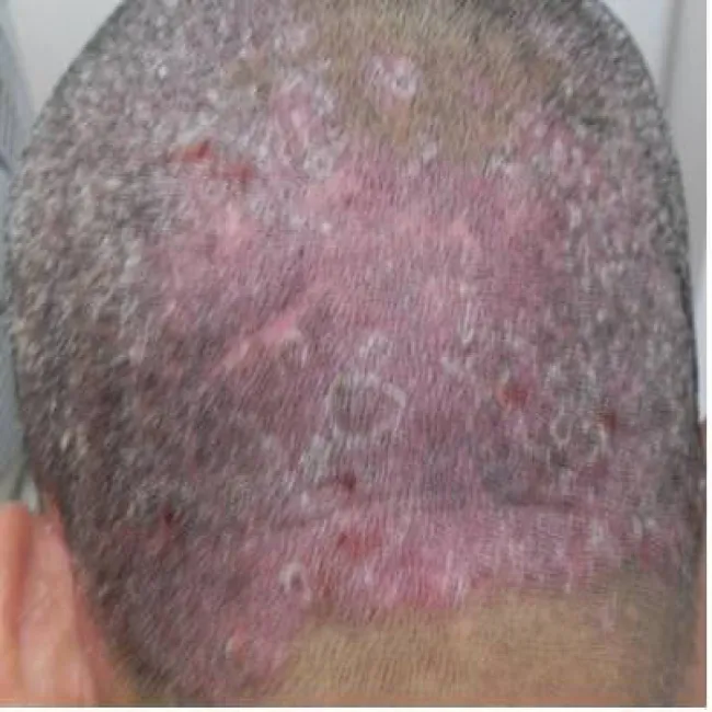 łuszczyca skóry głowy