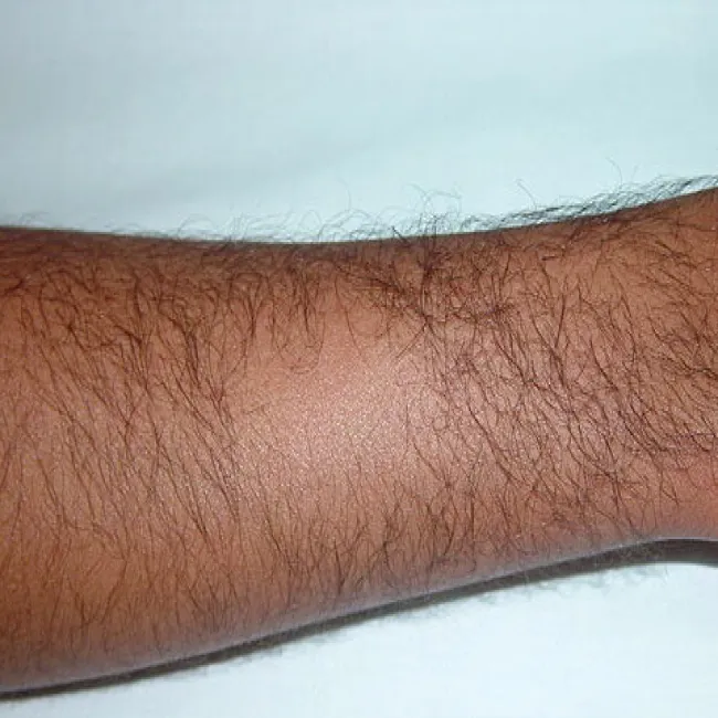 łysienie plackowate na rękach