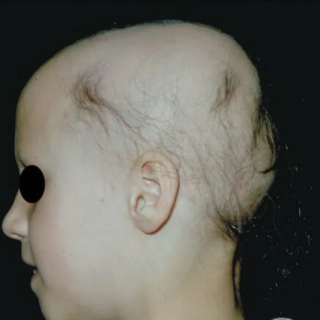 łysienie plackowate u dzieci zdjęcia