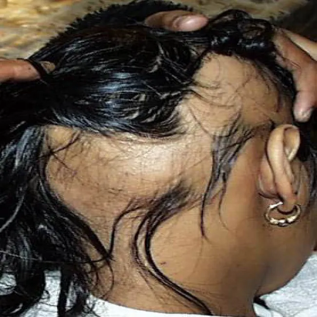 łysienie plackowate u kobiet