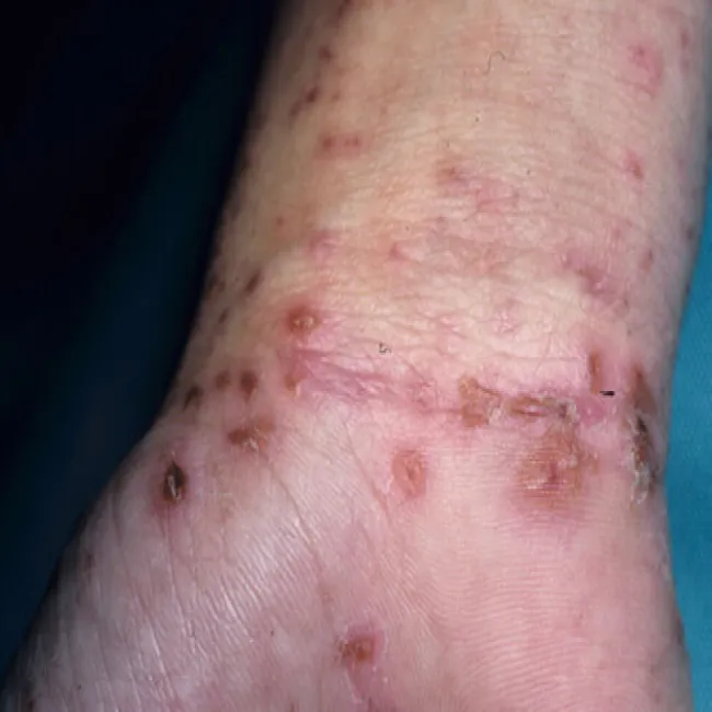 Świerzb na nadgarstku