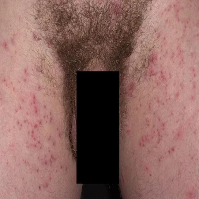 Świerzb okolic intymnych u mężczyzny