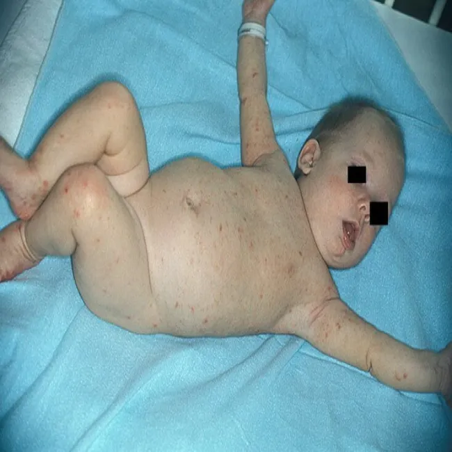 Świerzb u dzieci objawy