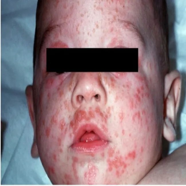 Świerzb u dziecka na twarzy