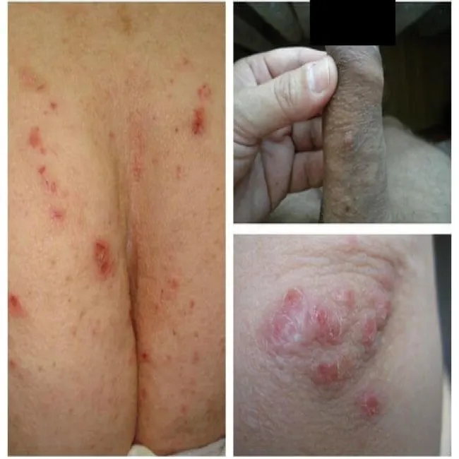 Świerzb wysypka grudkowa