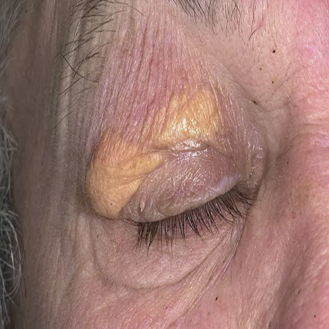 Żółta narośl na powiece kępki żółte 