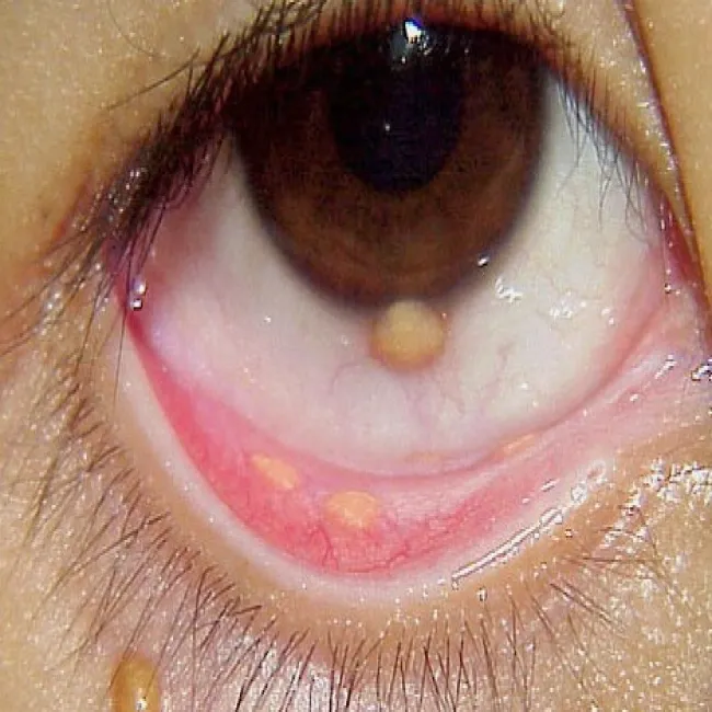 Żółtakoziarniniak młodzieńczy oko