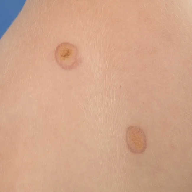 Żółtakoziarniniakowatość młodzieńcza choroba