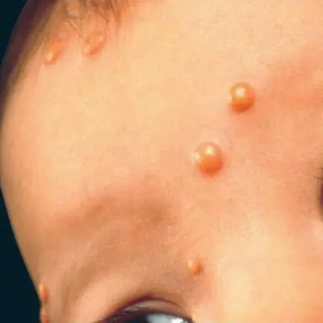 Żółte grudki na twarzy dziecka