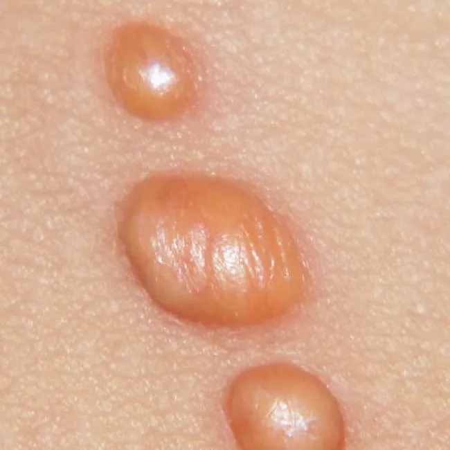 Żółte guzy na skórze żółtakoziarniniakowatość młodzieńcza 