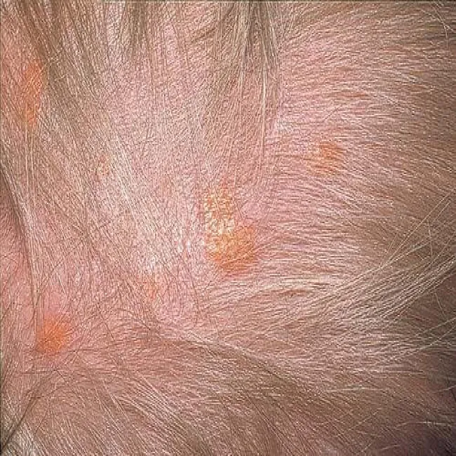 Żółte plamy na skórze głowy u dziecka