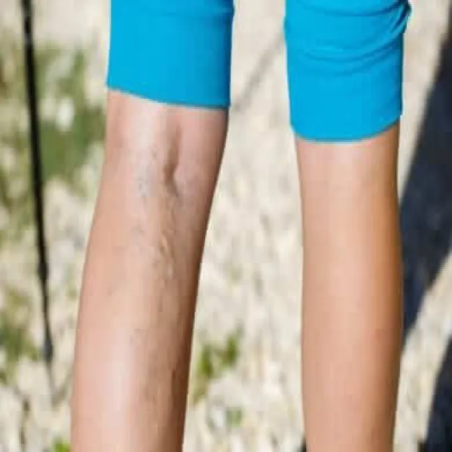 Żylaki kończyn dolnych u dzieci 