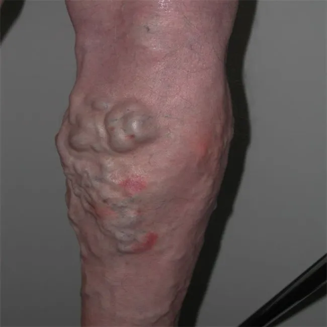 Żylaki wewnętrzne na nogach