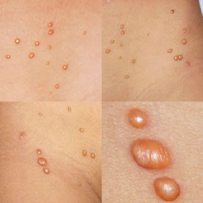 żółtakoziarniniak młodzieńczy 