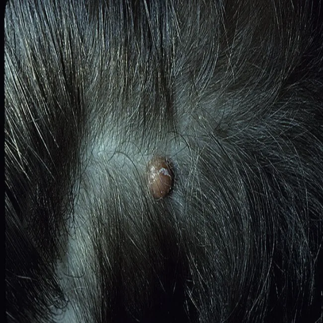 żółtakoziarniniakowatość młodzieńcza na skórze głowy