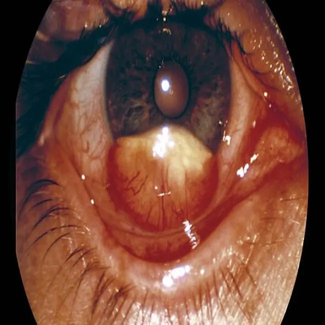 żółtakoziarniniakowatość młodzieńcza oka