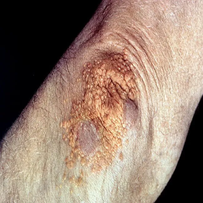 żółte grudki na łokciach