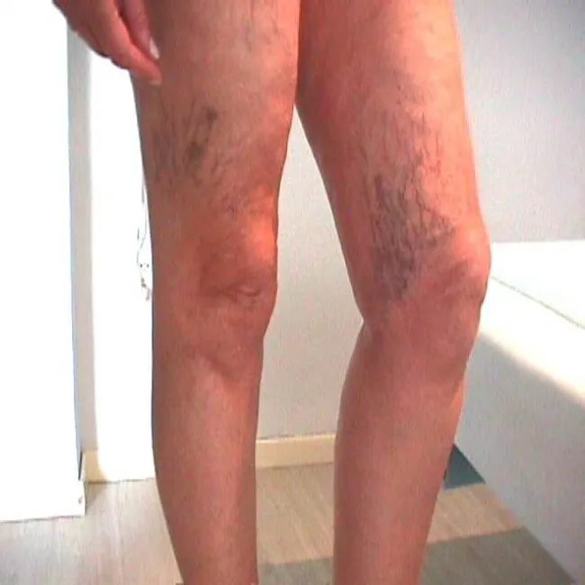 żylaki na nogach zdjęcie