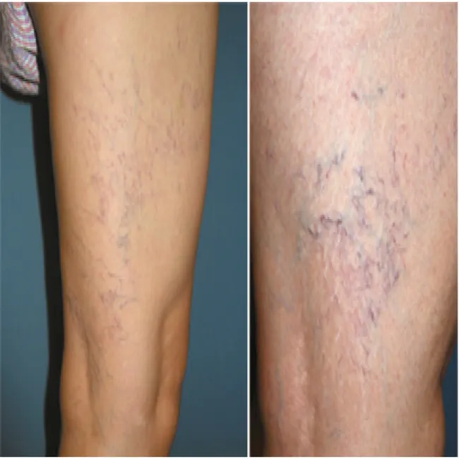 żylaki pajączki na nogach