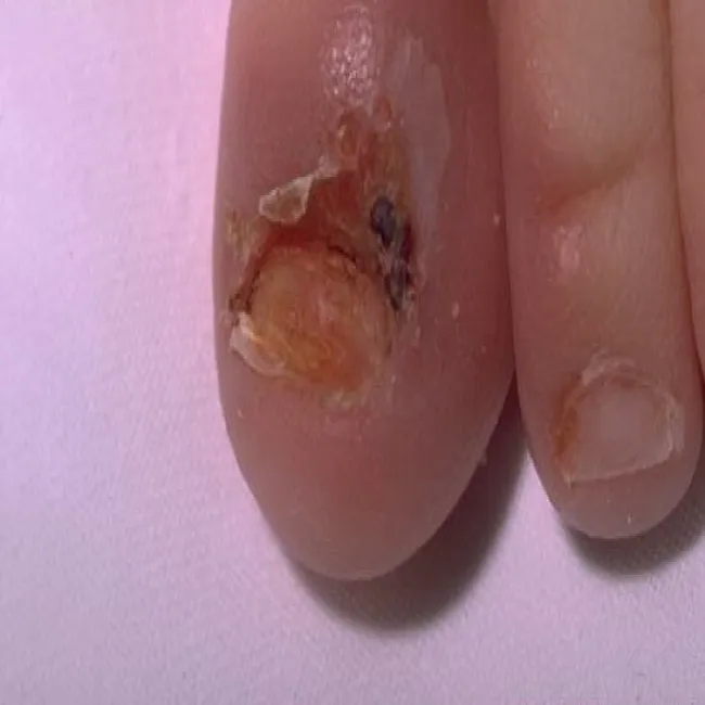 Acrodermatitis enteropathica zdjęcie