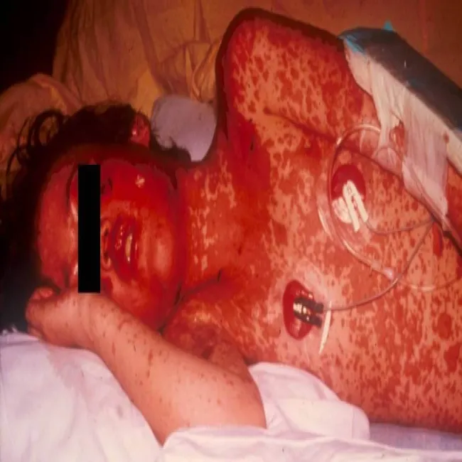 Alergia polekowa zespół Stevensa- Johnsona