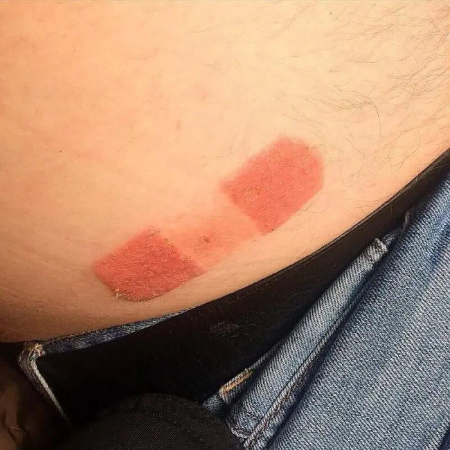 Alergiczne kontaktowe zapalenie skóry na plaster 