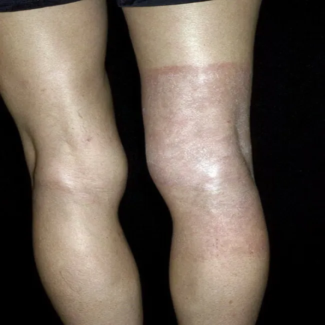 Alergiczne kontaktowe zapalenie skóry wywołane barwnikami