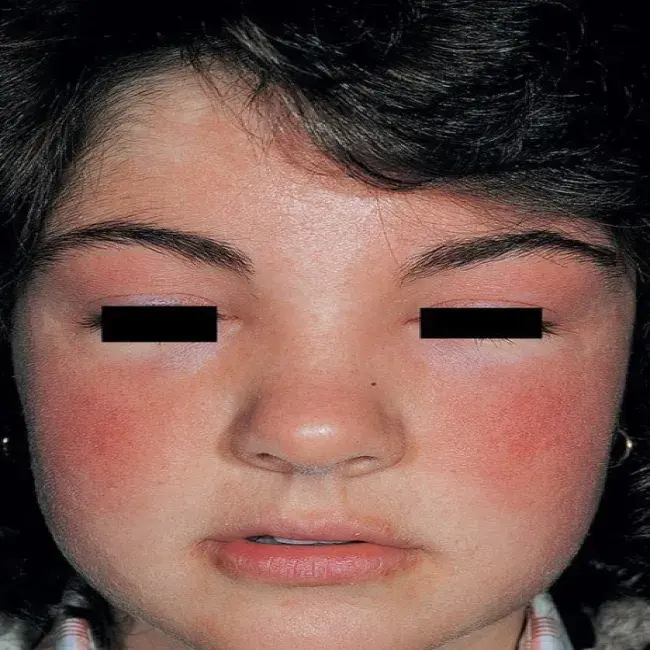 Alergiczne kontaktowe zapalenie skóry wywołane kosmetykami