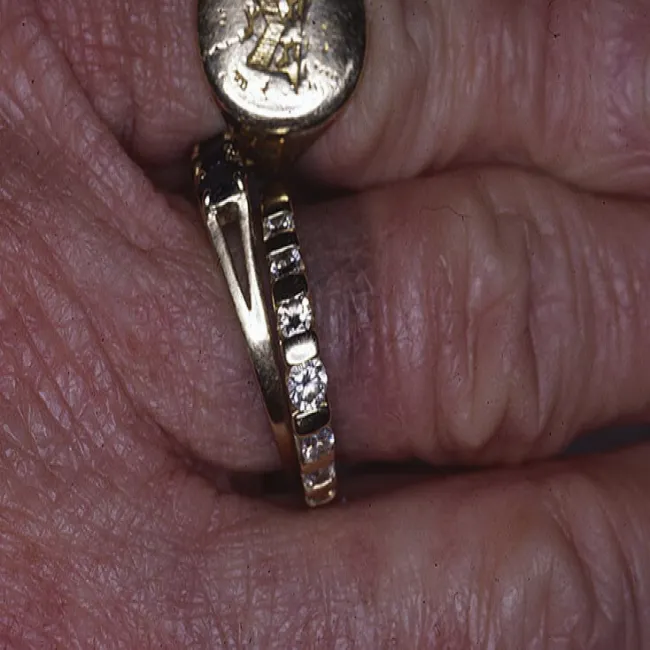 Alergiczne kontaktowe zapalenie skóry wywołane przez kontakt z metalami