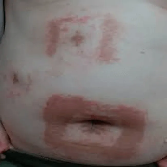 Alergiczne kontaktowe zapalenie skóry wywołane przez przylepiec