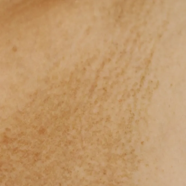 Amyloidozy skóry zdjęcie