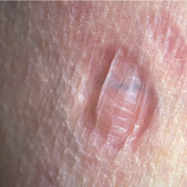 Anetoderma Schweningera i Buzziego 