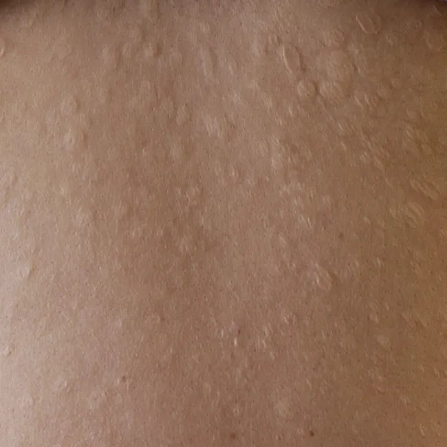 Anetoderma klasyczna Jadassohna 