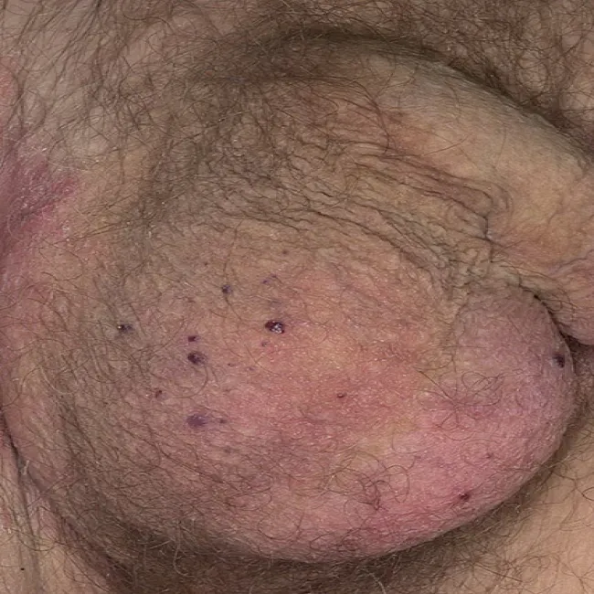 Angiokeratoma jąder