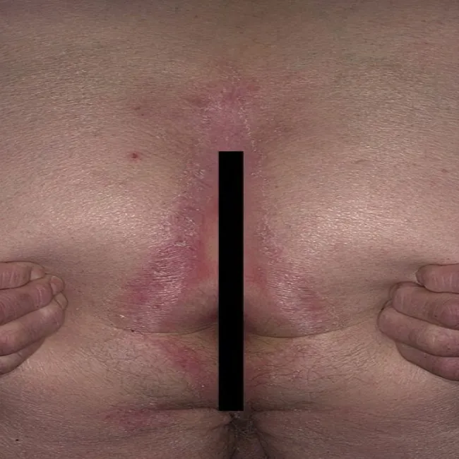 Atopowe zapalenie skóry między pośladkami