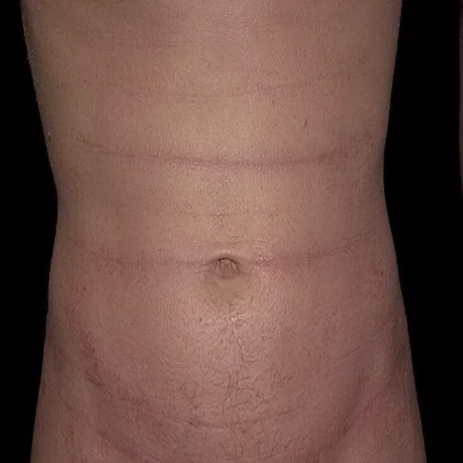 Atopowe zapalenie skóry na brzuchu