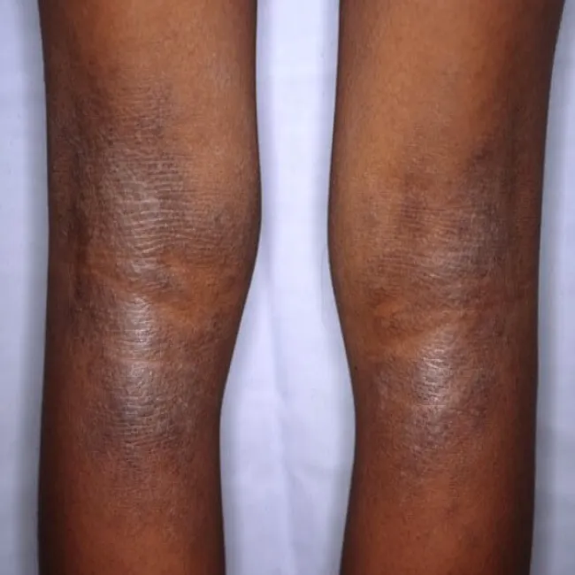 Atopowe zapalenie skóry na nogach