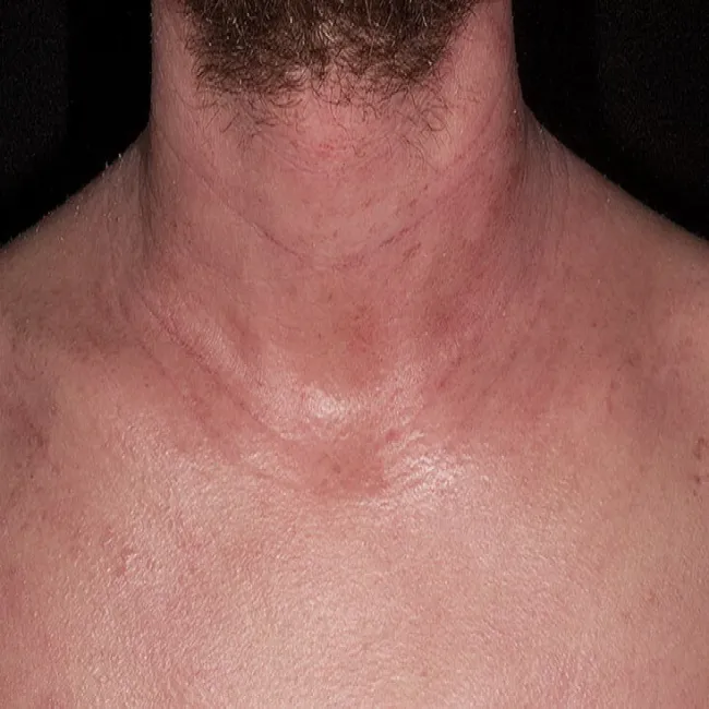 Atopowe zapalenie skóry na szyi zdjęcie