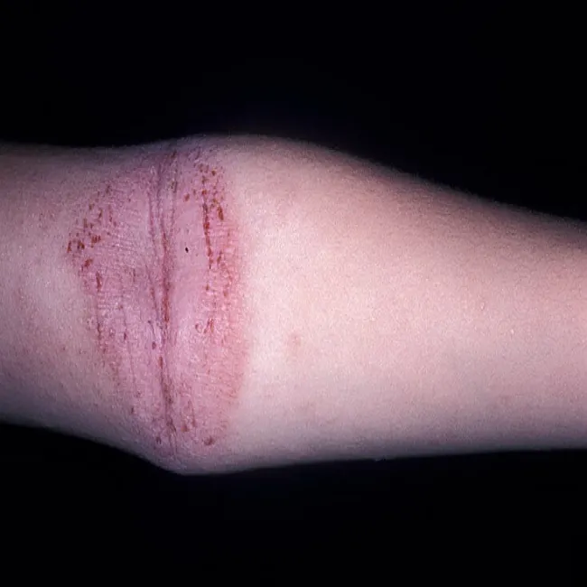 Atopowe zapalenie skóry na zgięciu ręki