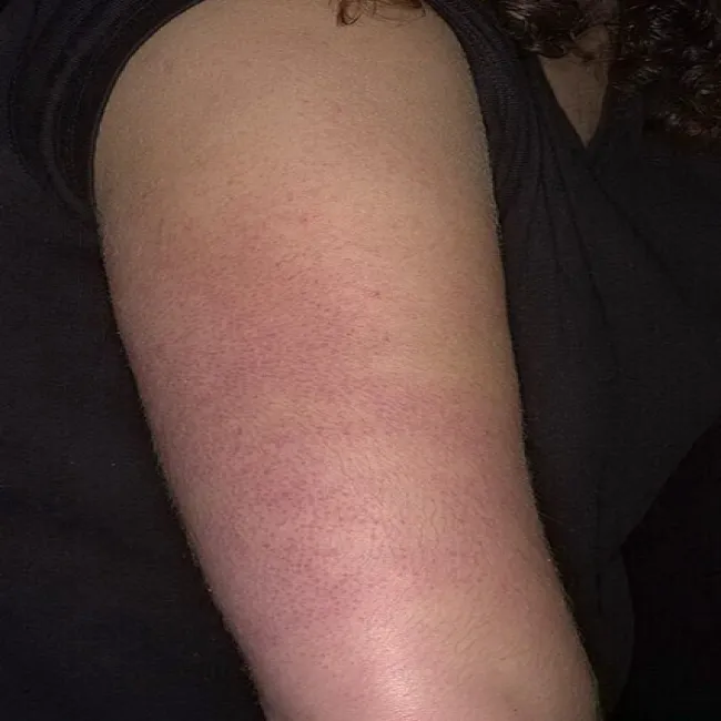 Atopowe zapalenie skóry ramion