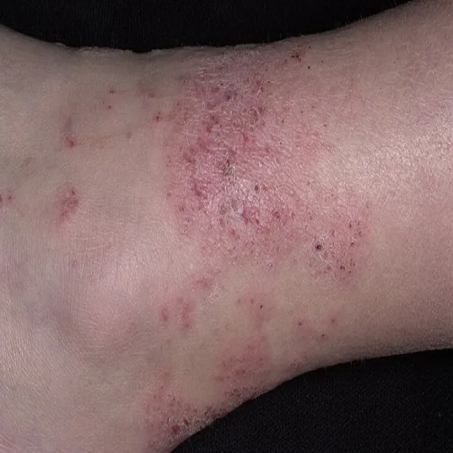 Atopowe zapalenie skóry u dorosłych