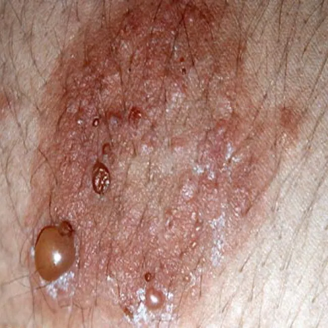 Bąble pokrzywkowe choroba Duhringa