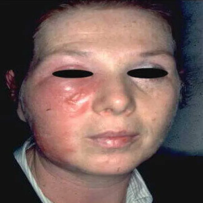 Bakteryjna choroba róża na twarzy