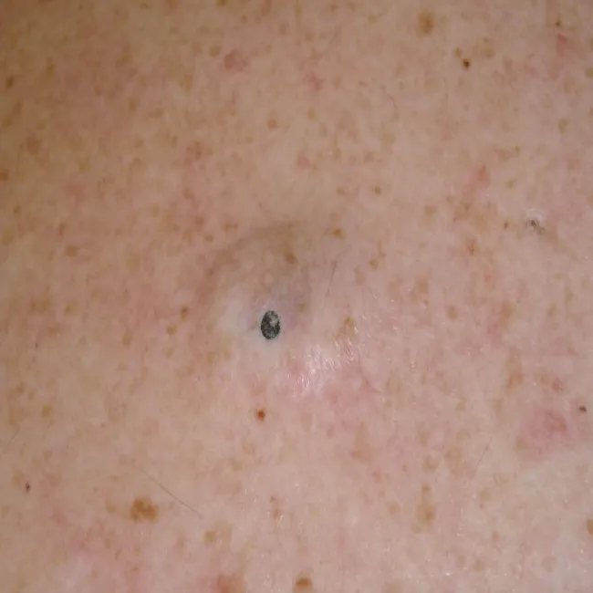 Bardzo głębokie zaskórniki