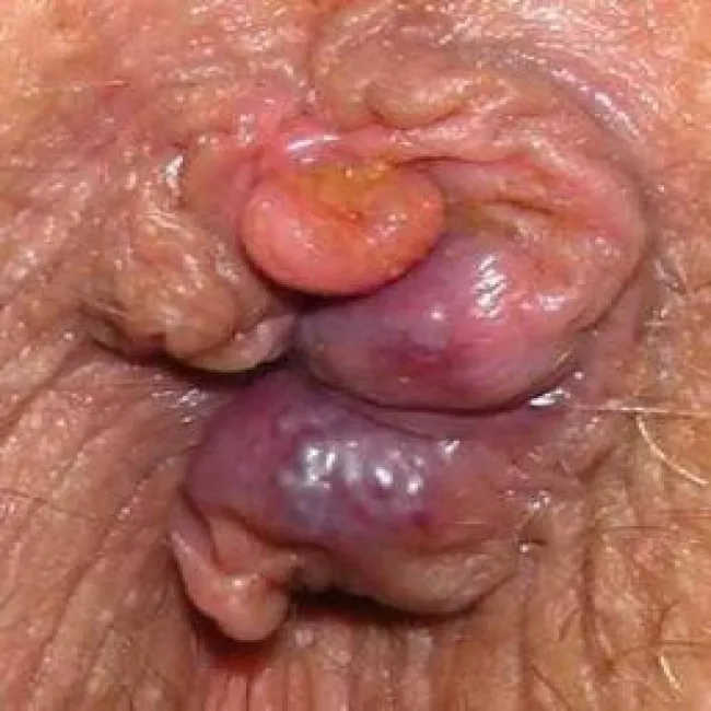 Bezbolesny guzek przy odbycie hemoroidy