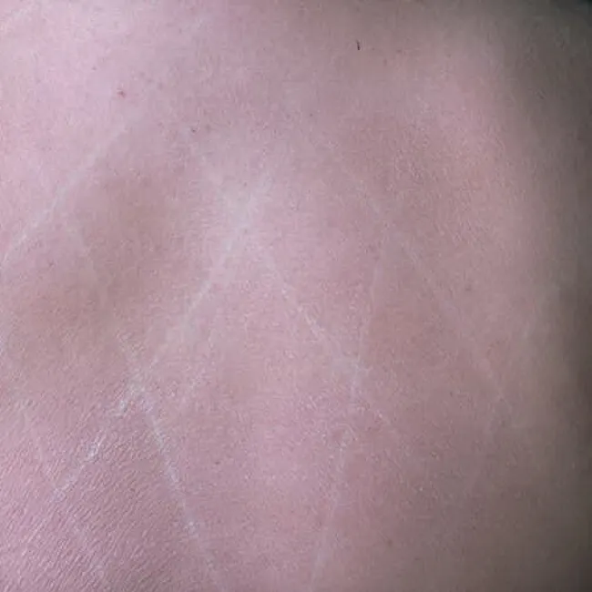 Biała pokrzywka na skórze